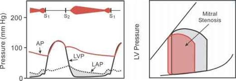 pressure volume loop mitral stenosis.